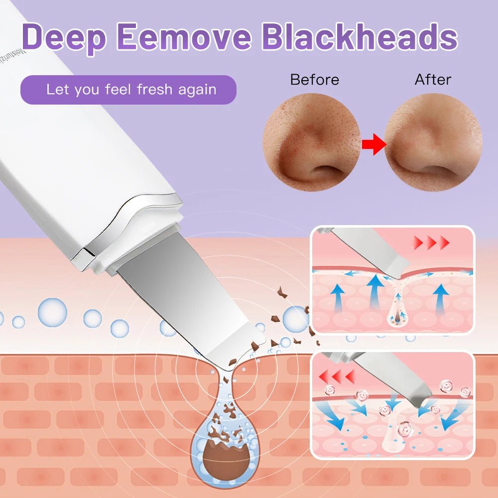 Ultrasonic Skin Scrubber & Blackhead Remover - 4USelects